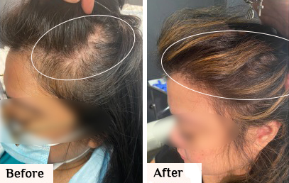 Before & After prp hair restoration